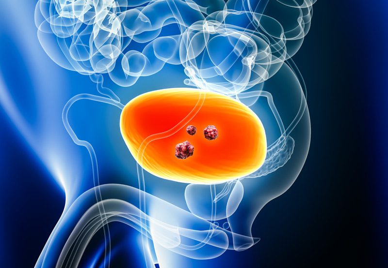 3D-rendered-image-showing-urinary-bladder-cancer