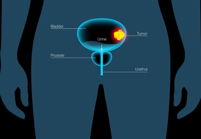 Illustration-showing-stages-of-bladder-cancer