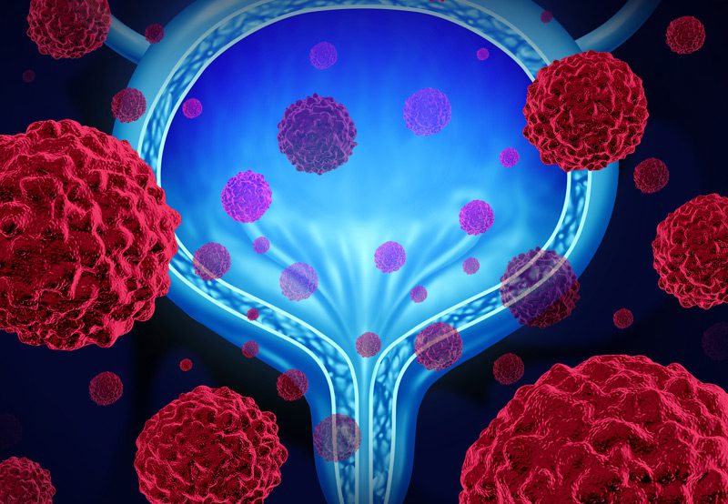 Image-illustrating-bladder-cancer-anatomy-and-affected-areas Image-illustrating-bladder-cancer-anatomy-and-affected-areas