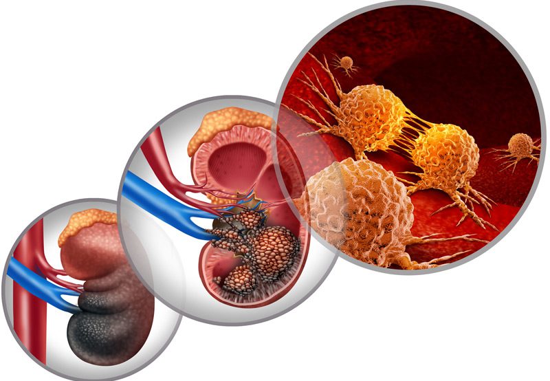 Image-illustrating-kidney-cancer-and-renal-health