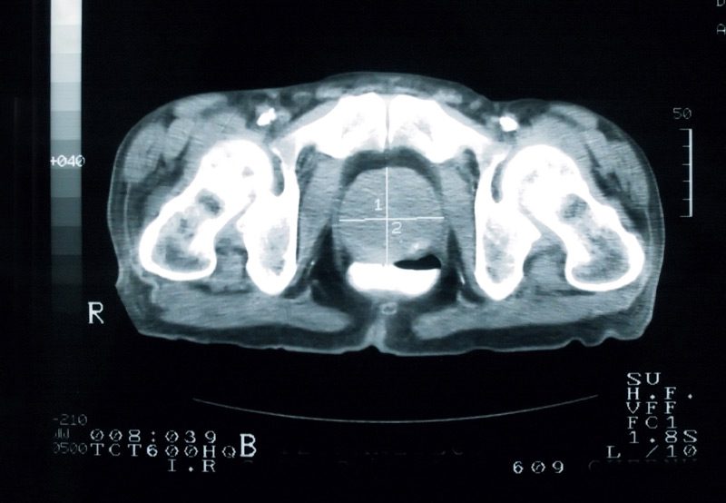 Image-of-cross-section-of-prostate-gland