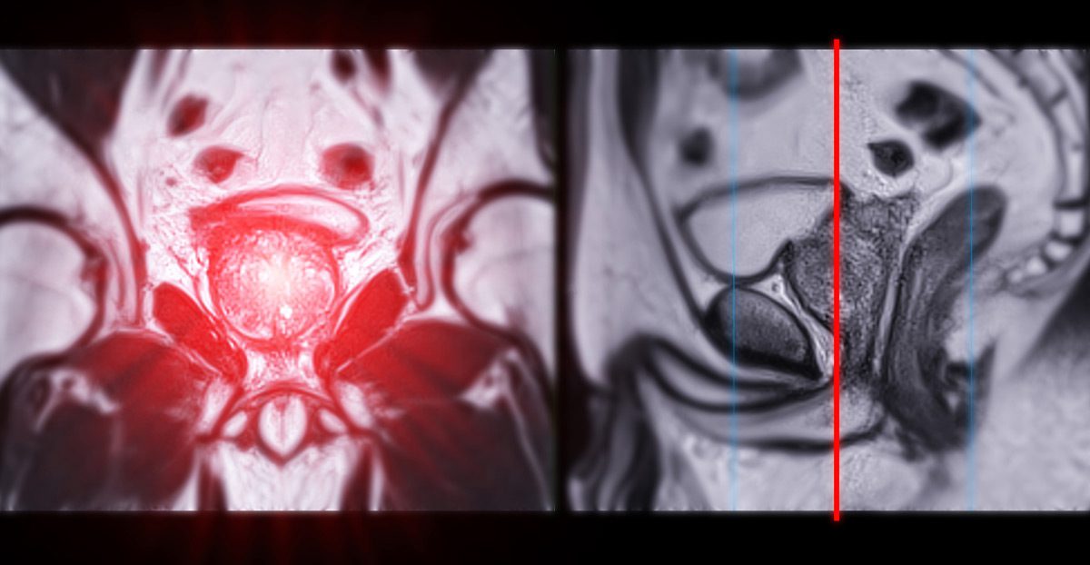 MRI-image-of-the-prostate-gland