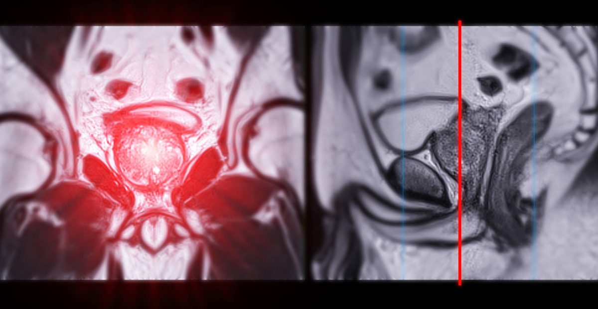 MRI-images-of-the-prostate-gland