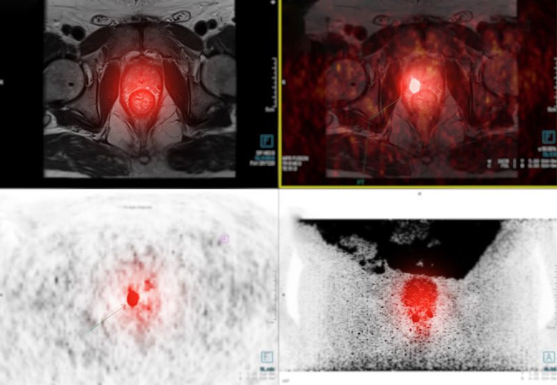 PET-scan-fusion-images-of-prostate-gland