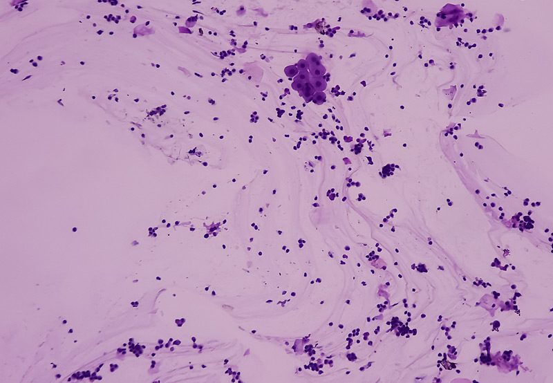 Photomicrograph-showing-urine-cytology-with-epithelial-cells