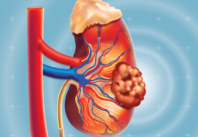 Vector-illustration-showing-kidney-cancer-anatomy
